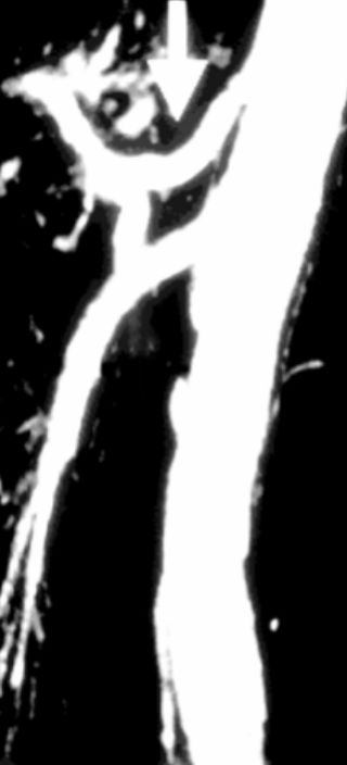 mra-chrevnyj-stvol