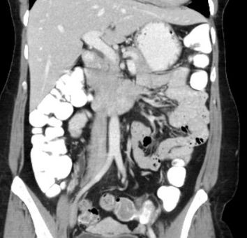 May-Turner syndrome