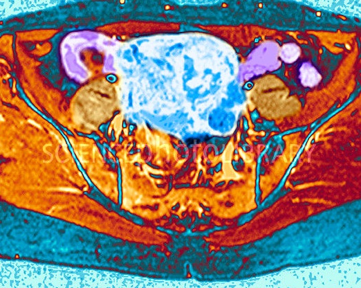 ^BUterine fibroid.^b Coloured magnetic resonance imaging (MRI) scan of a transverse (horizontal) section through a 48-year-old woman's pelvic region showing a large fibroid (blue) in her uterus (womb). A fibroid is a benign tumour of fibrous and muscular tissue. Most do not require treatment, but some can cause bleeding, pain and other disorders. Large fibroids may need to be surgically removed. MRI uses radio waves and a powerful magnet to produce slice images through the body.