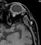 melanoma-t1