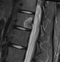osteoid-osteoma-pozvonka
