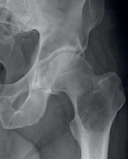 Plasmocytoma