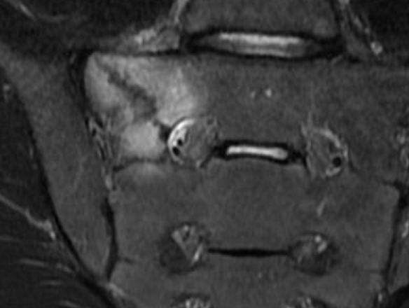 sacrum stress-fructure T2 MRI